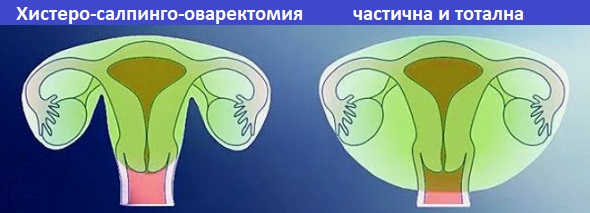 Хистеректомия Фигурин 2