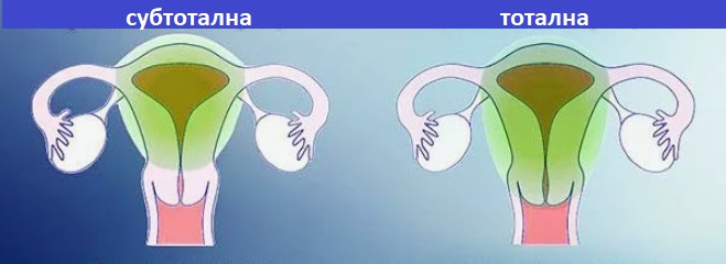 Хистеректомия Фигурин